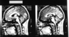 sp_brain_sagittal.jpg